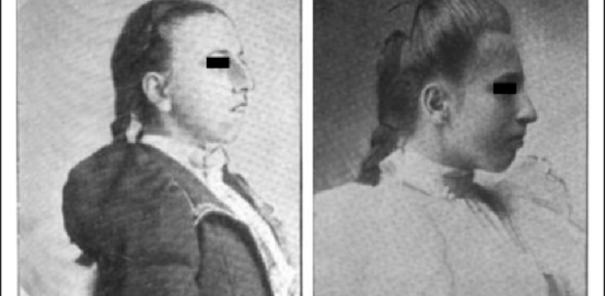 ZDROJ: THE FIRST DESCRIPTIONS OF DORSAL PRESERVATION RHINOPLASTY IN THE 19TH AND EARLY- TO MID-20TH CENTURIES AND RELEVANCE TODAY – SCIENTIFIC FIGURE ON RESEARCHGATE